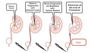 Facts Of Kidney Stones Kidney Stones Mehta Hospital