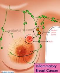 Breast cancer starts when normal cells transform into cancerous cells and these breast cells begin to grow out of control. Pinterest Log In Download Inflammatory Breastcancer Gailzu811 Collection By Gail Zusi 13 Pins 37 Followers Last Updated 4 Years Ago Colorectal Or Colon Cancer Is Considered The Most Commonly Occurring Cancer In America It Is Inflammatory Breast