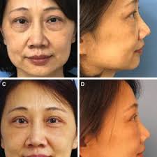 Case 2: (A) A female patient with thick eyelid soft tissue in both...