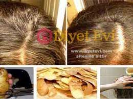 Sac Beyazlamasina Patetes Kabugu Peeling Potatoes Boost Hair Growth Hair
