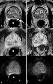 Mri scans can show if the cancer has spread outside the prostate … T2 And Diffusion Weighted Magnetic Resonance Imaging At 3t For The Detection Of Prostate Cancer With And Without Endorectal Coil An Intraindividual Comparison Of Image Quality And Diagnostic Performance European Journal Of