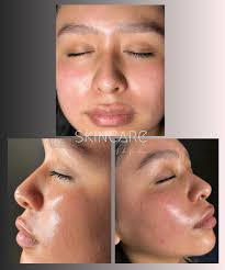 Results after ONE Co2 laser treatment