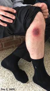The bite of the brown recluse spider (loxosceles reclusa) typically results in local, dermonecrotic skin lesions. Brown Recluse Spider Bite Jetem