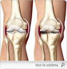 Les injections articulaires d'acide hyaluronique (ah) connaissent un grand succès, du fait de leur simplicité d'utilisation et de leur bonne tolérance. Arthrose Osteoarthrite Traitements Medicaux