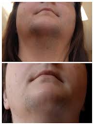 What 6 Months Of Spiro Looks Like On A Very Hirsute Woman Before And After Photo Linked Pcos