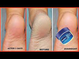How To Get Soft Feet Overnight Get Rid Of Rough Cracked Heels Youtube