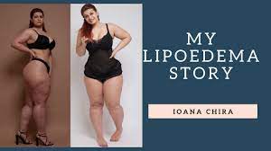 Instagram Fitness Star Ioana Chira (Ioana_Fit) On Living With Lipoedema