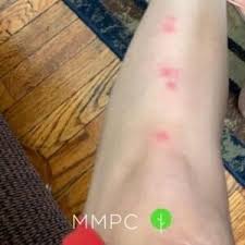 Image result for bedbugs bites