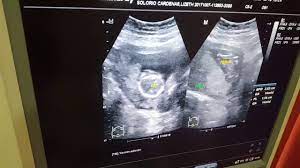 3 Meses Ultrasonido Youtube
