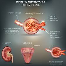 Rarely, renal diseases associated with hypoxia or autonomous erythropoietin production can cause secondary absolute polycythemia. Kidney Diseases Symptoms Causes Treatment Narayana Health