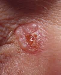 Mange dropper dette fordi de aldri blir solbrent på leggene. Hudkreft Felleskatalogen