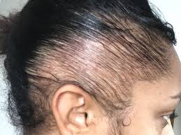 Hair loss can also occur on the sides of the head through hairstyles that pull the hair tightly away from the scalp, placing stress on the hair follicles along the sides of your head. Traction Alopecia Young Female Singer Warns Of Self Inflicted Hair Loss Don T Let It Happen To You