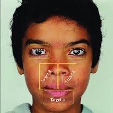 A 4-month-old female with right unilateral cleft lip and alveolus,...