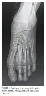 Persistent bone pain that gets worse over time and continues into the night swelling and redness (inflammation) over a bone, which can make movement difficult if the affected bone is near a joint Wolf In Sheep S Clothing Metatarsal Osteosarcoma Mdedge Hematology And Oncology
