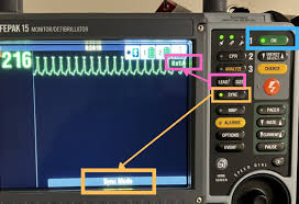 Image result for Synchronized Cardioversion