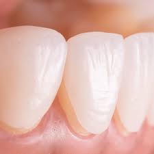 We did not find results for: E Max Veneers In Dubai Abu Dhabi Porcelain Dental Veneers Cost
