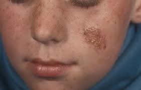 Image result for yellow scabs on the face in children