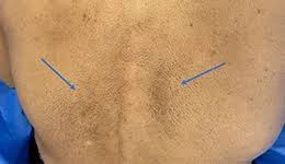 ‫ماکولار؛ علائم، علل و راه‌های درمان - داروخانه آنلاین زیوش‬‎