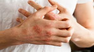 Itu pun jika mahu sembuh cepat. Kenali 4 Tanda Dan Gejala Herpes Zoster