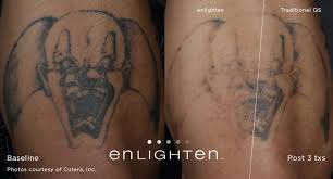 People make more money by removing tattoos by this method than the money made in putting the tattoo. Laser Tattoo Removal Premier Dermatology And Facial Surgery