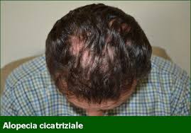 Ai 20 anni è soggetto ad una precoce (o precocissima) perdita dei capelli. Alopecia Classificazione E Trattamento Professione Farmacia