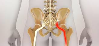 La sciatica (anche sciatalgia o lombosciatalgia) non è propriamente una patologia, bensì un sintomo che può avere alla sua base problemi di diversa natura. Sciatalgia Rimedi Naturali Ecco Gli Aiuti Giusti Per Ripartire Blog Dr Giorgini