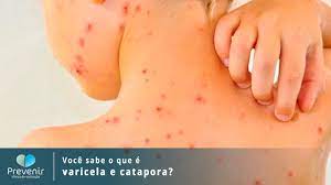 Voce Sabe O Que E Varicela E Catapora Prevenir