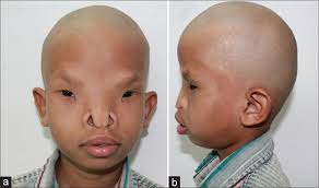 This condition most commonly occurs in infants when a flat nasal bridge and prominent epicanthal folds tend to obscure the nasal portion of the sclera. Modified Facial Bipartition