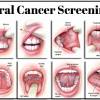 In the early stages, mouth cancer rarely causes any pain. 1