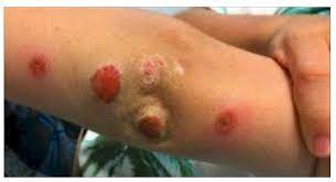 L'infezione da stafilococco nei bambini può manifestarsi anche con eruzioni cutanee simili a quelle. Infezione Da Stafilococco Nei Bambini Contagio E Sintomi News Cronaca
