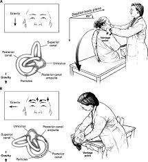 Fortunately, bppv is one of the easiest types of vertigo to treat. Diagrammatic Representation Of Performance Of The Dix Hallpike Maneuver Download Scientific Diagram