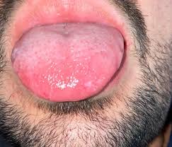 Habe Seit Gestern Zahneputzen Rote Flecken Auf Der Zunge Und Brennen Gesundheit Und Medizin Innere Medizin