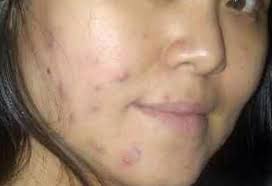 Cara Merawat Wajah Berjerawat Secara Tradisional Jerawat Wajah Wajah Pria