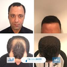 قبل وبعد زراعة الشعر