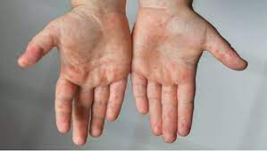 Os sintomas mais comuns são febre, tosse seca e cansaço. Mais Um Caso De Sindrome Inflamatoria Multissistemica Pediatrica E Registrado Em Pe Petrolina E Regiao G1