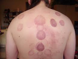 According to tcm practitioner casco, it is expected that over several weeks of repeated cupping treatments the bruising will decrease as the stagnation resolves. Explanation Of Cupping Therapy Discolorations Post Treatment