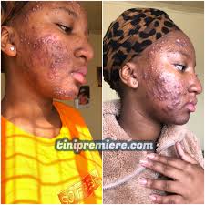 Guys how can one remove and treat these 😭💔 😢 I give up 💔😭"  #TiniPremiere