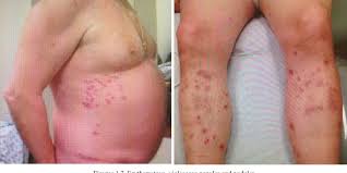 If the lesions of granuloma annulare are. Pdf Generalized Granuloma Annulare In A Folliculocentric Distribution Semantic Scholar