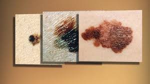 The skin is the body&#x27;s largest organ. Dermatologists Show How To Spot And Identify 3 Types Of Skin Cancer Wbir Com