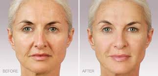 I have a crease not so deep on my forehead between my eyes, i think is called frown line. Wrinkle Reduction Dr Beth Comeau Columbia Md