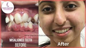 The best way to straighten teeth without braces involves using some sort of cle. Teeth Braces Cost In Bangalore Crooked Teeth Correction Teeth Straig Teeth Braces Teeth Correction Teeth Straightening