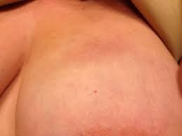 An infection may be the cause, especially if you are pregnant. Inflammatory Breast Cancer Norway Pdf Ppt Case Reports Symptoms Treatment