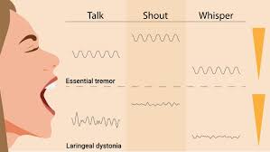 Image result for Essential Tremor