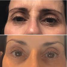 5 Most Frequently Asked Questions About Fibroblast Treatment