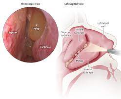 Initially, these are not larger than small drops of water. Nasal Polyps Rmi