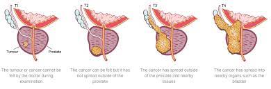 Your situation is very similar to mine. Sunshine Coast Urology What Is Prostate Cancer
