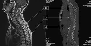 Image result for Vertebral Compression Fracture