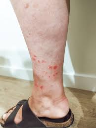 Image result for Vasculitis