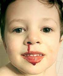 Nosebleed - Wikipedia
