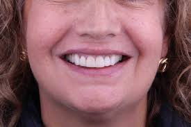 Implantes Dentales en Bogotá: Sonrisas Renovadas con el Dr. Jorge Tobar